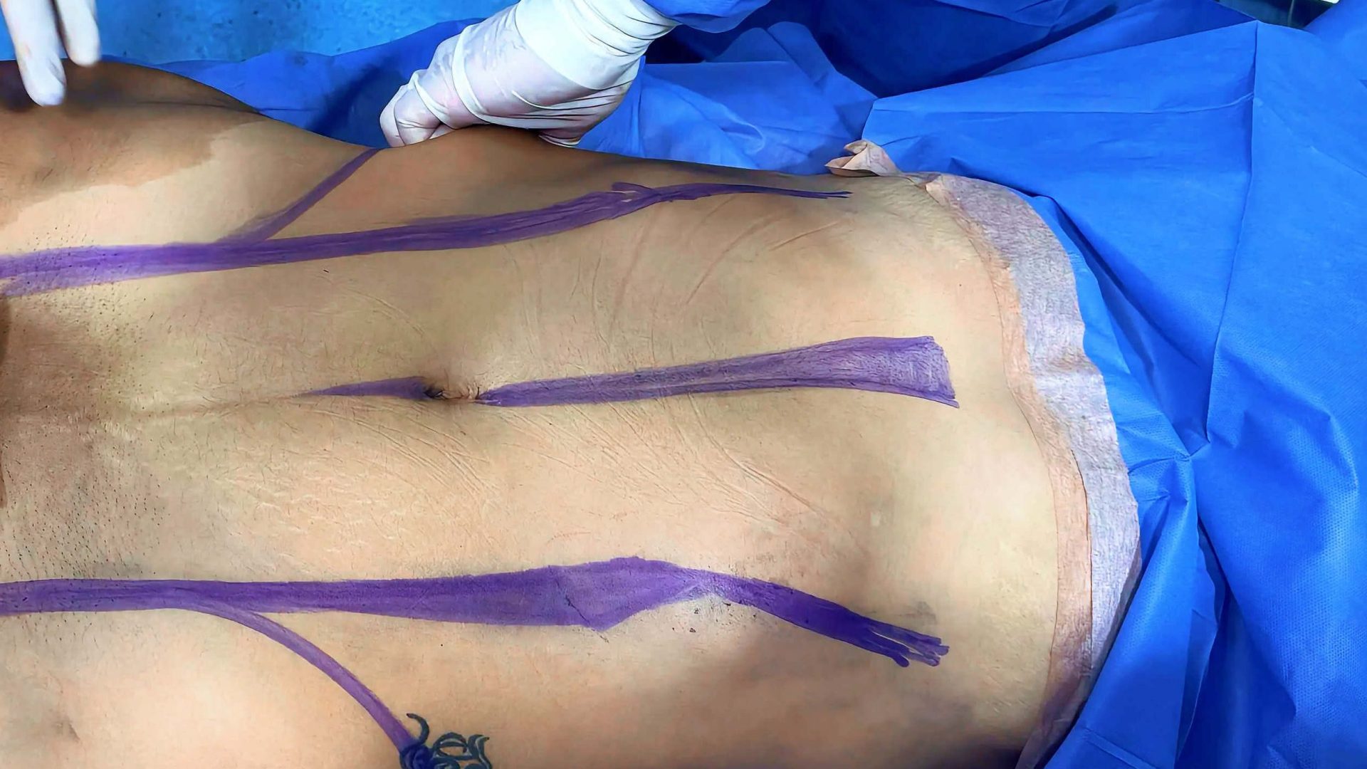 abdominosplatia